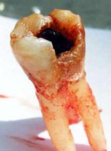 decayed tooth